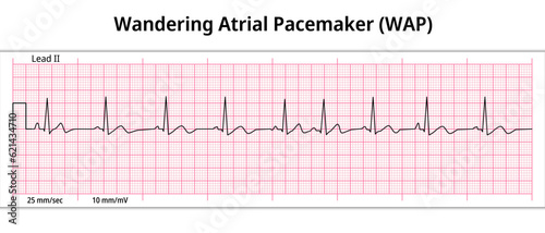 ECG Wandering Atrial Pacemaker (WAP) - 8 Second ECG Paper - Electrocardiography Vector Medical Illustration