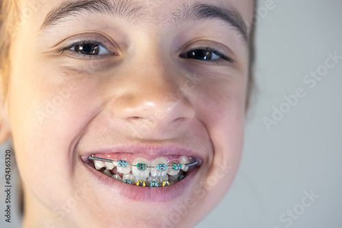 Teenage girl with braces on her teeth, close-up of a smile.