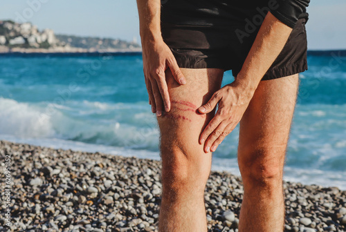 A jellyfish sting burn on a man's leg, on the beach