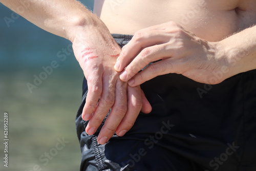 A jellyfish sting burn on a man's hand, on the beach