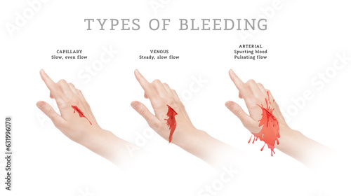 Three main types of bleeding