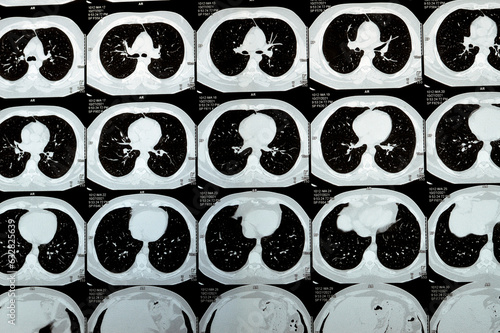 Multi slice CT scan of the chest showing normal study, normal appearance of the lungs, parenchyma, pulmonary vasculature, mediastinal structures, no adenopathy, no pleural effusion, no abnormality