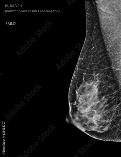 X-ray Digital Mammogram left side MLO view .