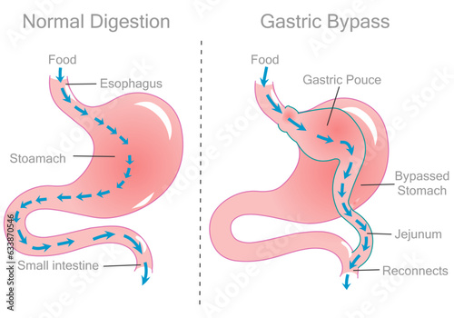Gastric bypass surgery jejunum. Stomach reduction by pass, operation. For obesity, diabetes surgery. Cross section anatomy, diagram. Digestion illustration vector