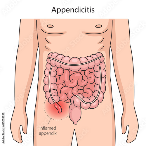 Appendicitis inflammation of the appendix diagram schematic vector illustration. Medical science educational illustration