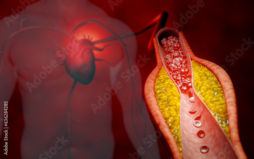 Hyperlipidemia or arteriosclerosis. Blocked artery concept and human blood vessel as a disease with cholesterol fat buildup clogging. Clogged arteries, Cholesterol plaque in the artery. 3D Rendering