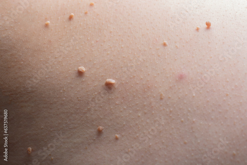 Several warts on the body close-up.