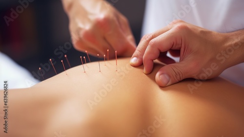 Akupunktur beim Heilpraktiker - feine Nadeln stimulieren die Akupunkturpunkte auf der Haut. 