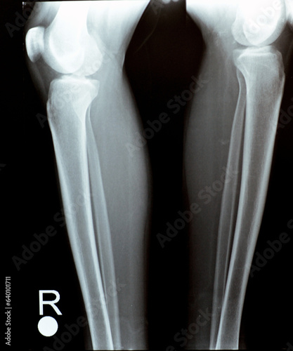 Plain X ray of both right and left knee joints with lower part of femur and upper parts of tibia and fibula and patella showing normal knee join of a young male that complains painful joint for MRI