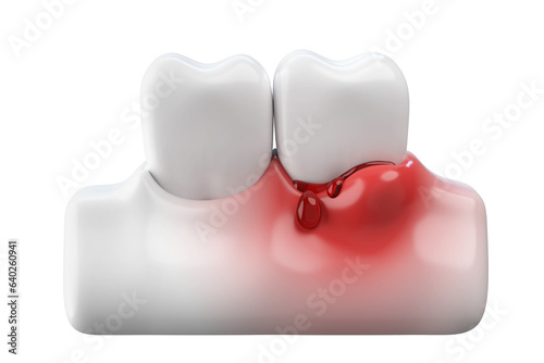 Bleeding gums and white teeth, gums disease or gingivitis concept. 3D rendering.