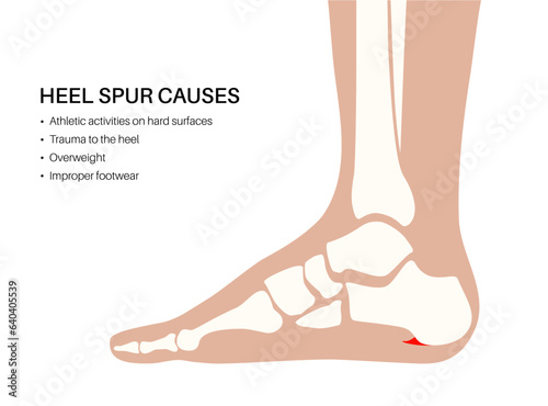 Heel spur causes