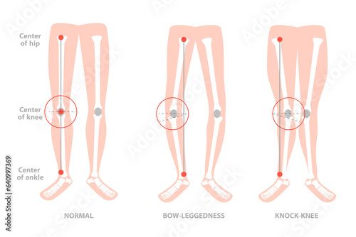 3D Isometric Flat Conceptual Illustration of Valgus Deformity , Cosmetic Pathology