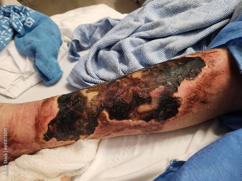 Superficial leg skin necrosis with ulcerations - gangrenous tissues