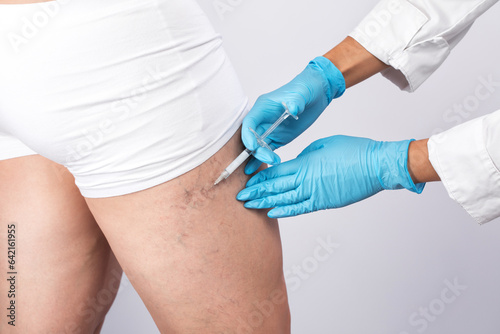 doctor shows the dilation of small blood vessels of the skin on the leg. Medical inspection and treatment of Telangiectasia. sclerotherapy procedure