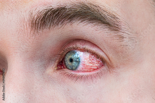 Man with red eye, macro shot. Conjunctivitis infection. concept of eye disease, Allergic conjunctivitis hyperemia