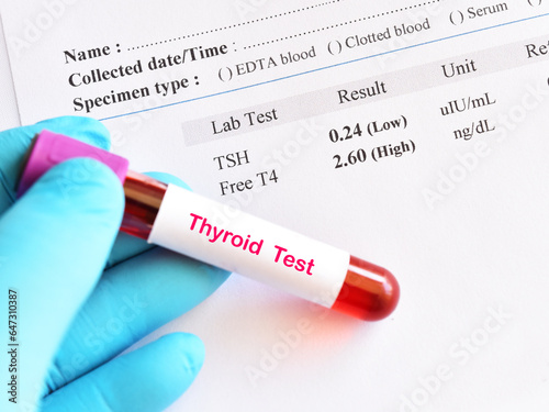 Blood sample tube with abnormal thyroid hormone test result