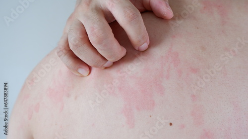 Close up image of skin texture suffering severe urticaria or hives or kaligata. Allergy symptoms.