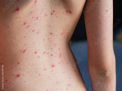 Persons back with chickenpox (varicella) blisters on his skin.