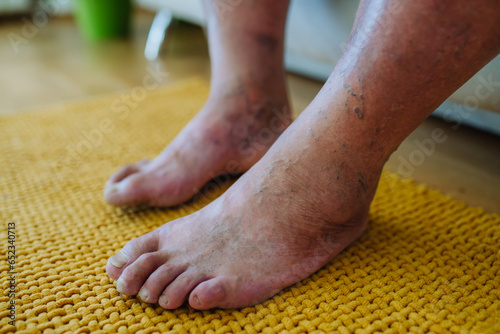 A close-up shot of man's feet with diabetic foot complications.