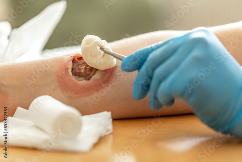 Wound care concept: Symbolizing change of dressing and cleaning and debridement of a wound with a realistic fake wound