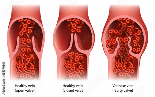 Chronic Venous Insufficiency or venous reflux.Venous Disease Varicose vein Faulty valve. Healthy vein