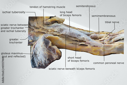 dissection image of the muscle of the thigh with showing sciatic nerve and popliteal fossa