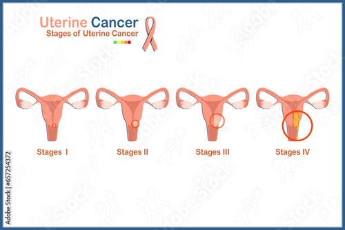 Flat medical vector illustration concept of 4 stages of uterine cancer on white background.