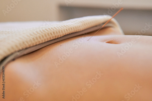 close up of acupuncture fertility treatment applied to the woman uterus area below the navel