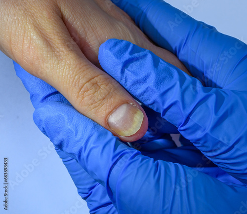 Pożółkły paznokieć przez łuszczycowe zapalenie płytki paznokcia, łuszczyca 