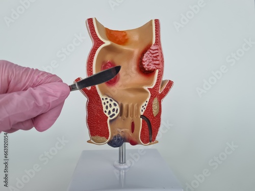 Doctor is holding scalpel anatomy of rectum problem