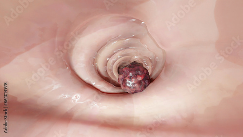 Colorectal cancer, malignant tumor in intestine, Endoscope inside colonoscopy, gut intestine, Colon polyp removal, colonic polyps search, Polypectomy, intestinal carcinoma, bowel neoplasia, 3d render