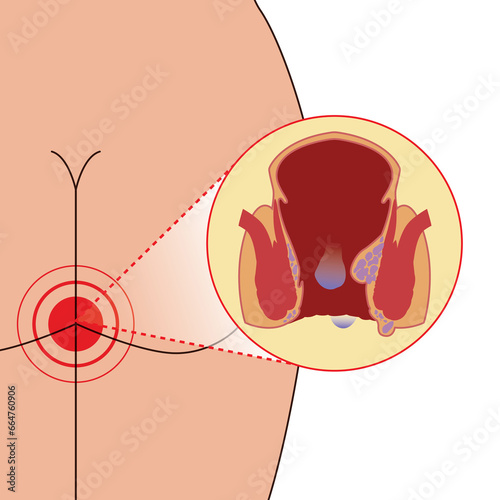 Emorrhoids on anal blood focus thrombosis, illustration on white background