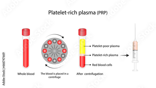 Platelet-rich plasma (prp). Autologous conditioned plasma, is a concentrate of PRP extracted from whole blood. After centrifugation, extract PRP and inject hair, skin or knee. Vector Illustration