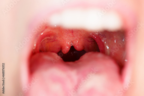 Cleft, bifurcation of the uvula. congenital malformations.