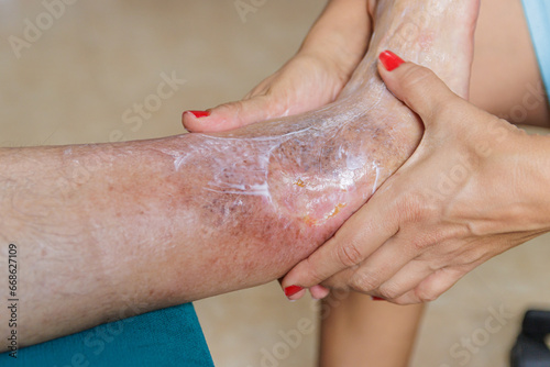 Home health care for an elderly person. Leg with ulcer due to diabetes.