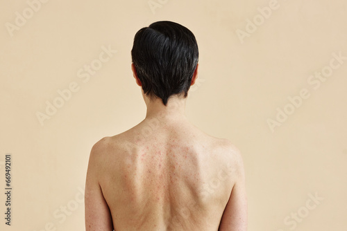 Minimal rear view of adult woman with rash spots on bare back standing against beige background, copy space