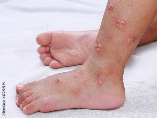 foot child asian Infection blister chicken pox dermatology measles medical allergic skin disease reaction red stickers virus hfmd