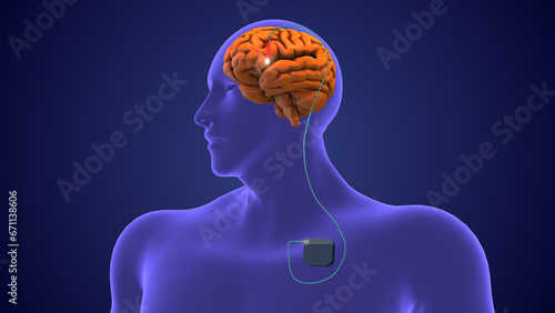 Deep brain stimulation medical concept 