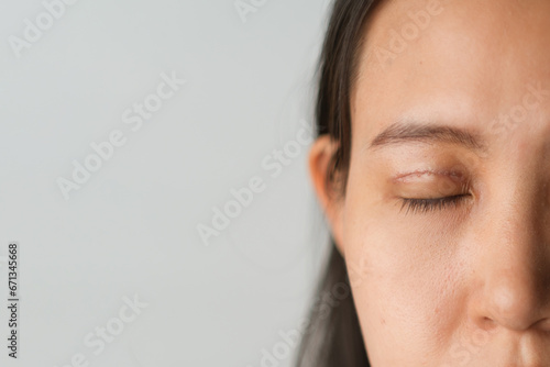 Asian woman with upper blepharoplasty surgery concept. Medical double eyelid plastic surgery, face view closing eyes with bruises and stitching on the eyelids. white background blank copyspace.