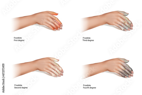The four frostbite stages.Skin injury that occurs when exposed to extreme low temperatures, causing the freezing of the skin or other tissues.
