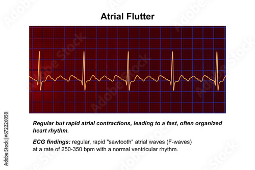 ECG in atrial flutter, an abnormal heart rhythm characterized by rapid, regular contractions of the atria, 3D illustration