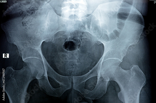 Hip joints digital radiographic examination reveals normal appearance of hip joins, multiple pelvic phleboli, bilateral coxa profunda, preserved spherical contour of femoral head, selective focus