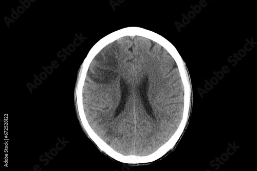 CT scan of human brain imaging on a black background. Xray showed cerebral infarction in hemiparesis patient in hospital.Doctor did medical treatment.Computer tomography scan of brain.Emergency care.