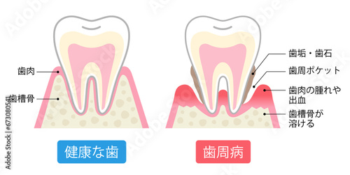 歯周病と健康な歯 比較 断面図