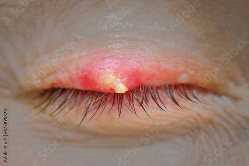 Burst abscess with pus on eyelid. Eye diseas with swollen, inflamed eyelid. Chalazion on upper eyelid close up. Chalazion on eyelid. Demodicosis mite disease, demodex. Selective focus