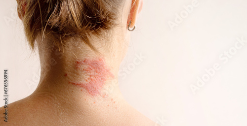 Manifestation of atopic dermatitis as a red itchy spot on a woman’s neck, close-up, rear view, copy space. Dermatology, allergy, itching, red spot or rash on skin