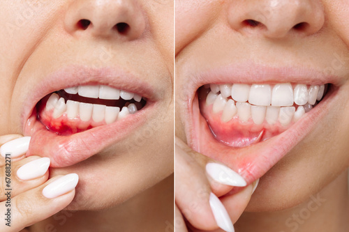 Two shots of a young woman with red bleeding gums and health gums before and after treatment. Result of curing of gum inflammation. Close up. Dentistry, dental care. Stomatitis, ulcer