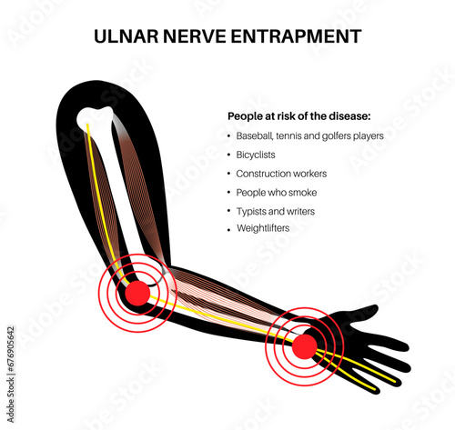 Ulnar nerve entrapment