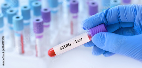 Doctor holding a test blood sample tube with SHBG test on the background of medical test tubes with analyzes