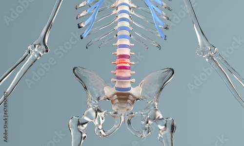 Compression fracture in the lumbar spine with glass skeleton